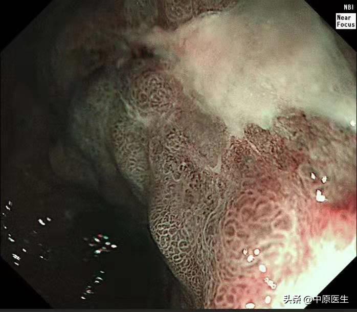 胃部怀疑是溃疡，细心专家又选择窄带光放大检查发现是胃癌