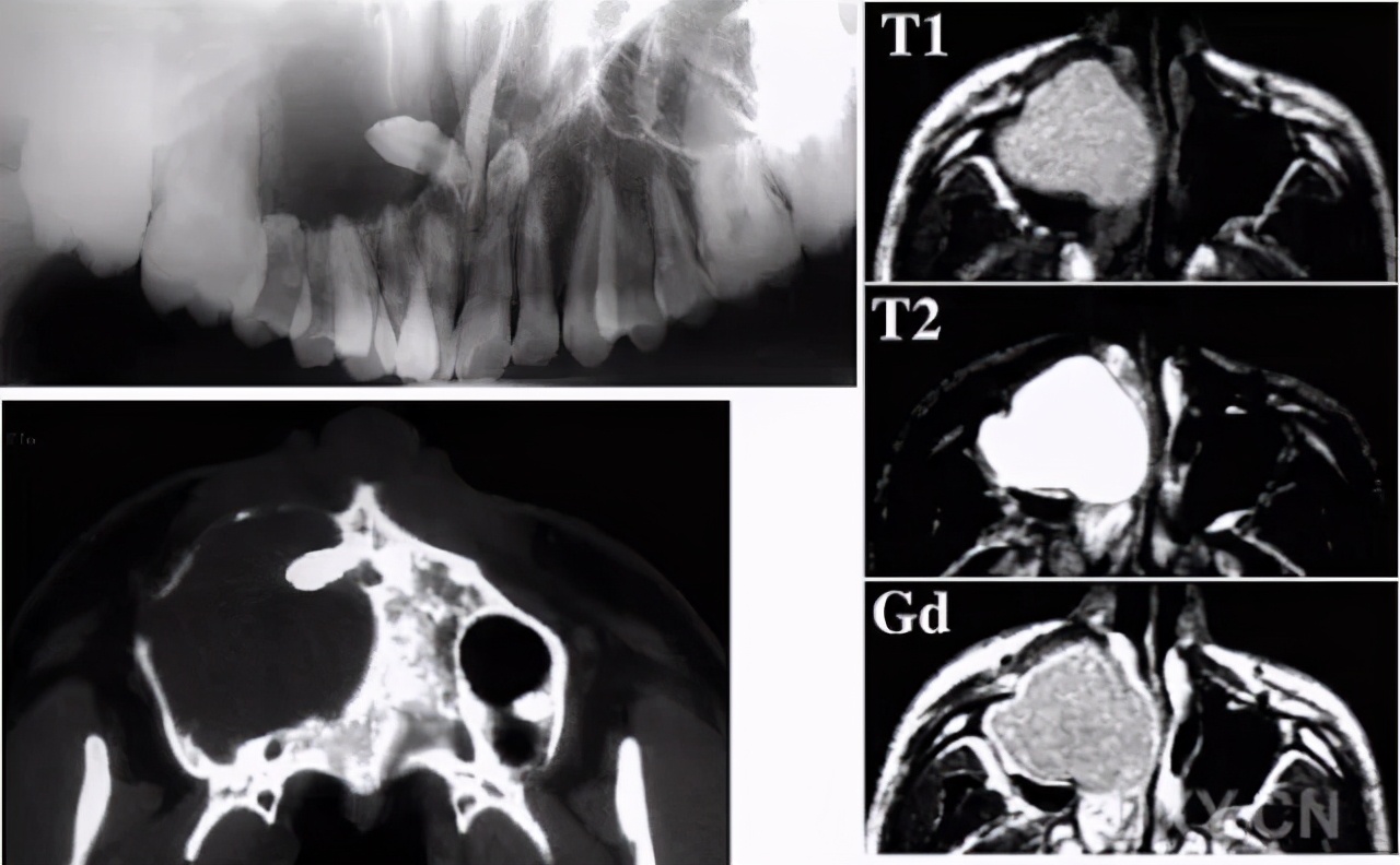 鼻窦囊肿导致脸部疼痛怎么办,鼻窦囊肿导致脸颊疼痛