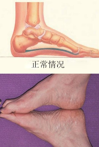 扁平足穿没有足底支撑的鞋,如何改善扁平足穿鞋的效果