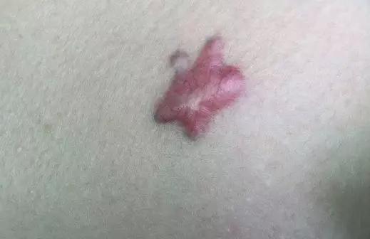 剖腹产的疤痕增生怎么除疤,疤痕体质如何才能正确除疤