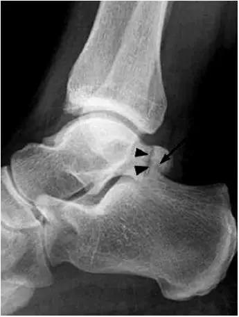 踝关节撞击症问诊,踝关节撞击综合征的x线表现