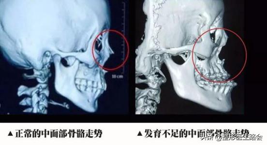 面中部凹陷下巴微翘,朱元璋式下巴怎么矫正