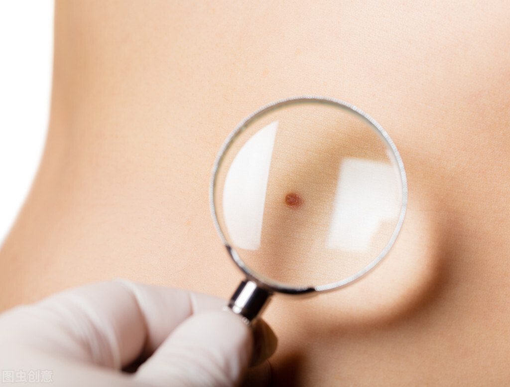 点痣后留疤了怎么办,点痣怕留疤抹什么药