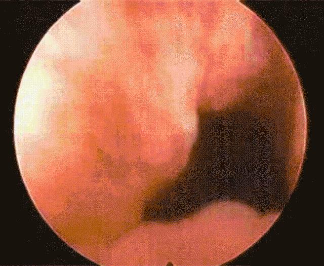 胆结石疼痛为什么发作在晚上,胆结石发作为什么都在后半夜