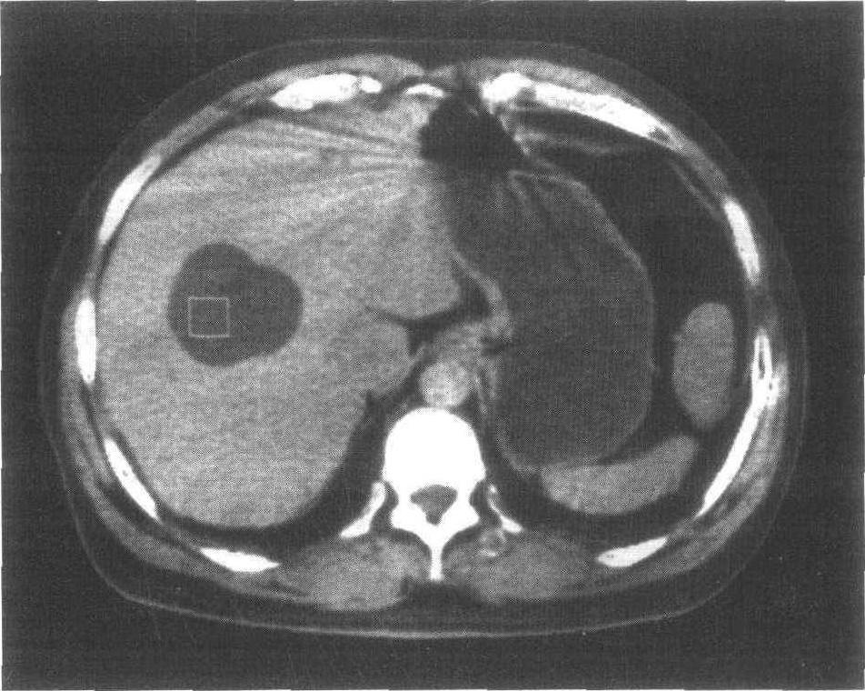 肝为什么会长水泡？发现肝囊肿需定期复查，哪些肝囊肿不能忽视？
