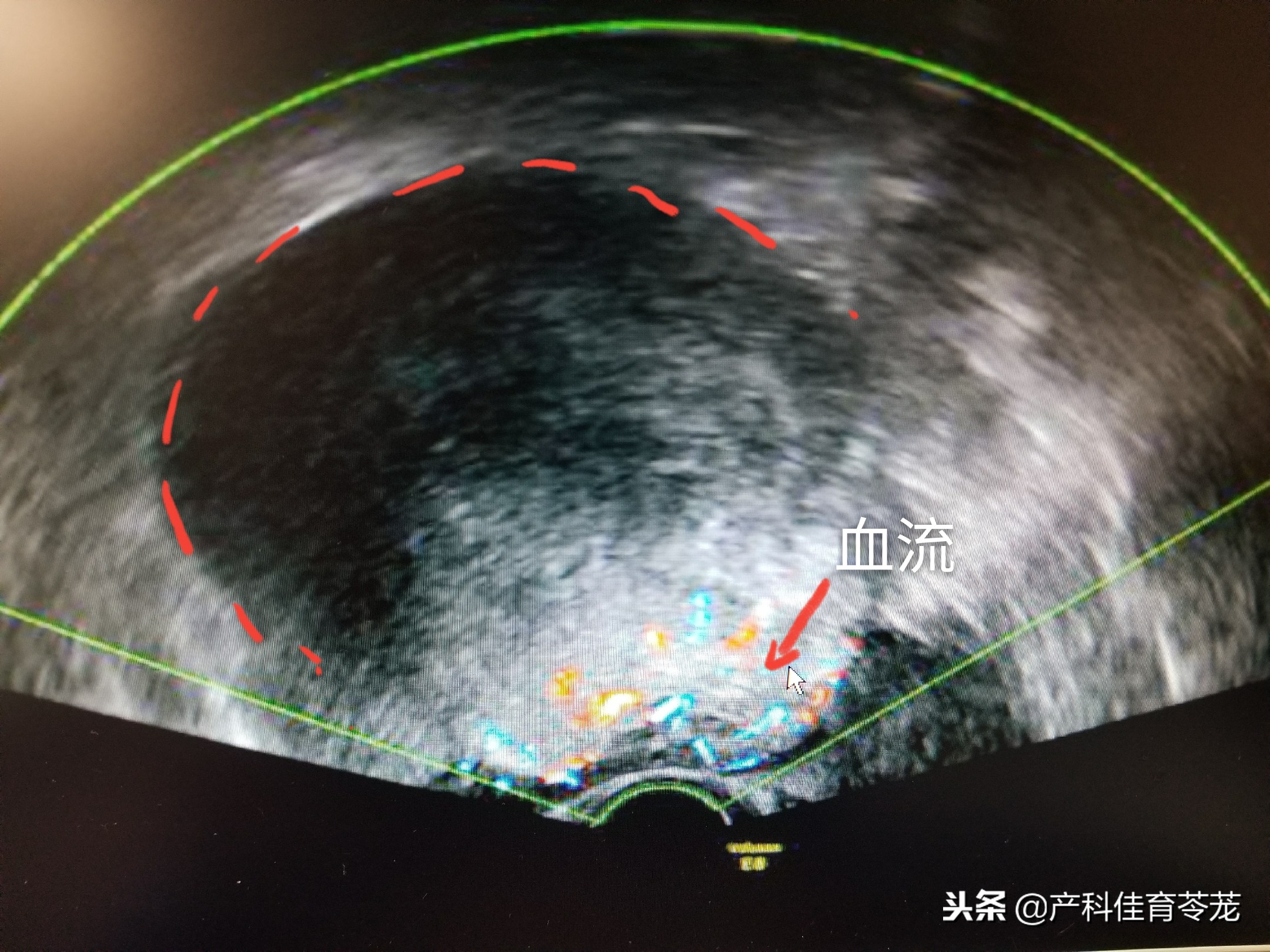 做b超能看见卵巢吗,妇科b超结果显示卵巢什么意思