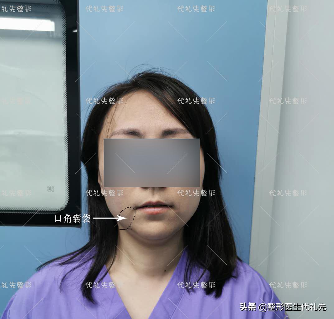 口角囊袋是美容界的难题吗,口角囊袋是整形后遗症么