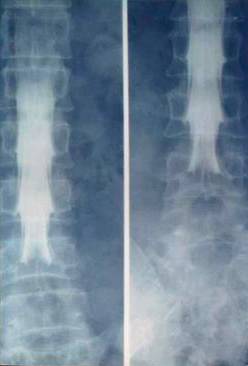 腰椎间盘突出症的临床诊治策略,腰椎间盘突出症的临床诊治