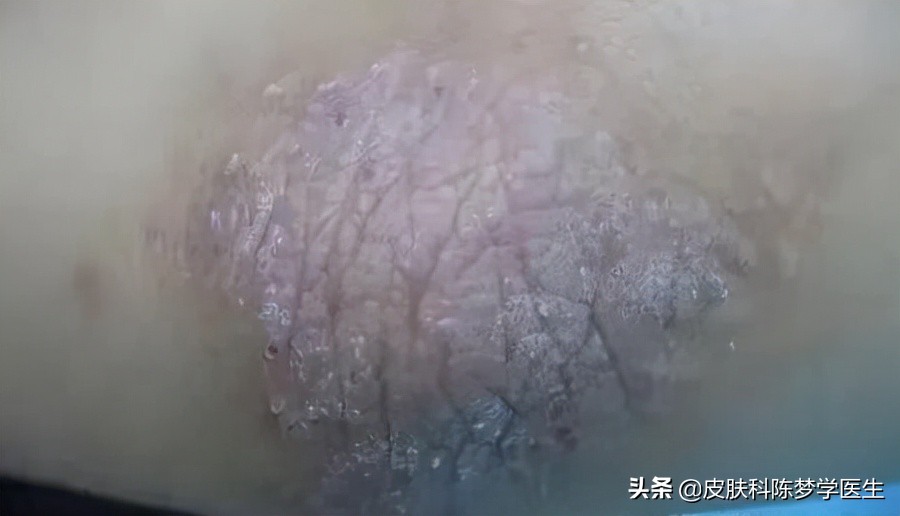 皮肤上的红斑可能是牛皮癣吗,红斑和脱屑的牛皮癣