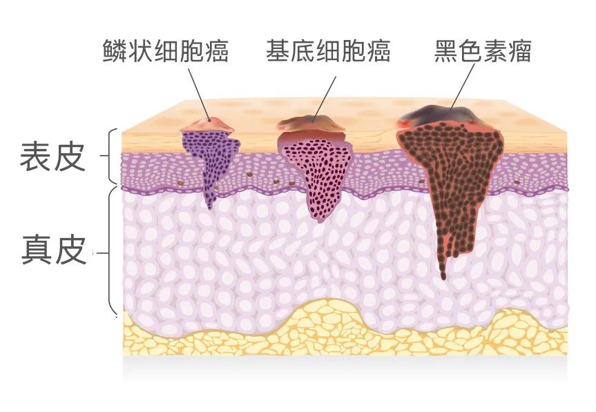 自己买激光笔点痣安全吗,家用激光笔点痣