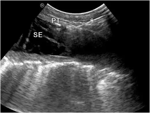 ct引导下穿刺活检诊断的分析,超声引导下穿刺活检什么样子的呢