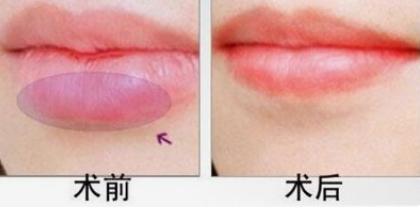 唇部的塑造步骤,唇部美容的方法