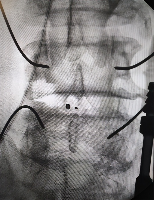 70岁大爷长期抬腿治腰椎间盘突出,腰椎间盘突出一个老头锻炼视频
