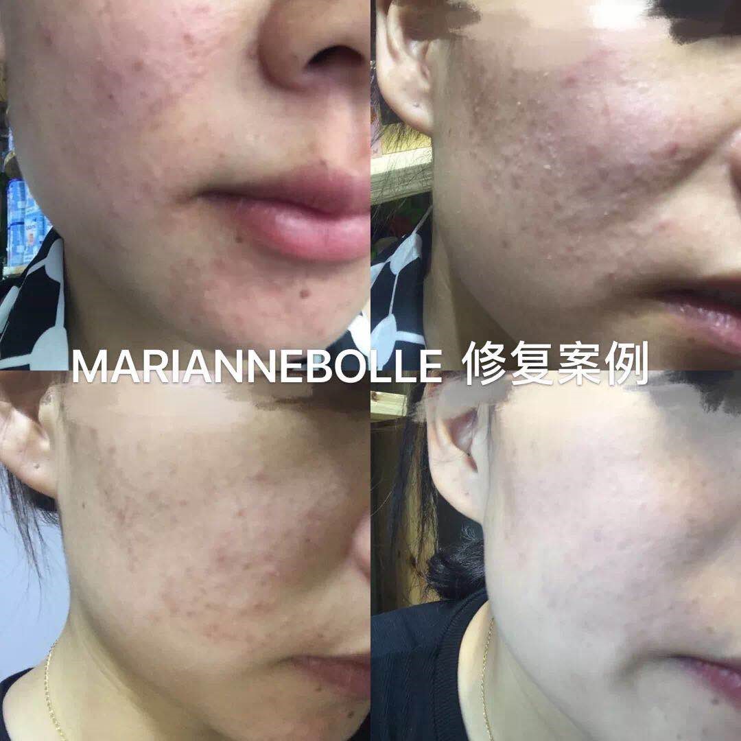 玛丽安保莱湿敷后要洗脸吗,玛丽安保莱急救水敷了会冒痘吗