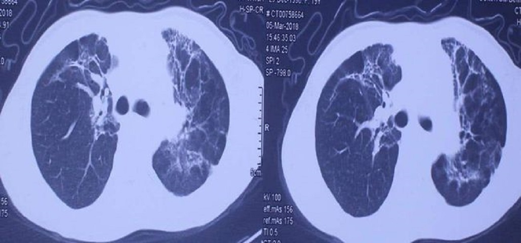 百草枯到底多可怕,百草枯多少会失去毒性