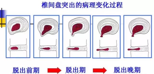 弯腰时腰部有压迫感是腰突吗,弯腰久了背后疼痛是什么病