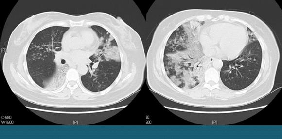 肺里咳出的痰对身体有害吗,从肺里咳出痰带血丝