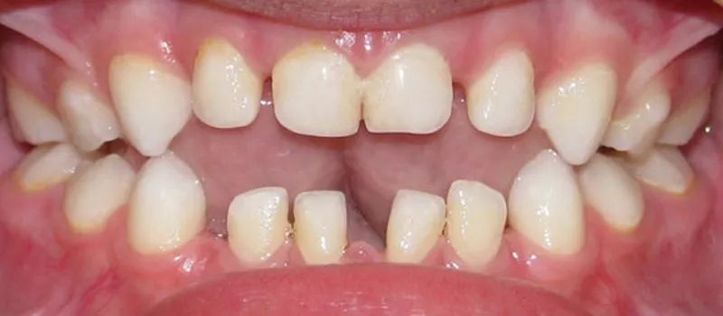 如何避免吃饭时咬到腮帮子或舌头,咬到舌头是不是准备吃肉呢