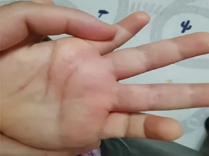 天一热手上就起一层小疙瘩还很痒,两只手上长密集的小疙瘩很痒很红