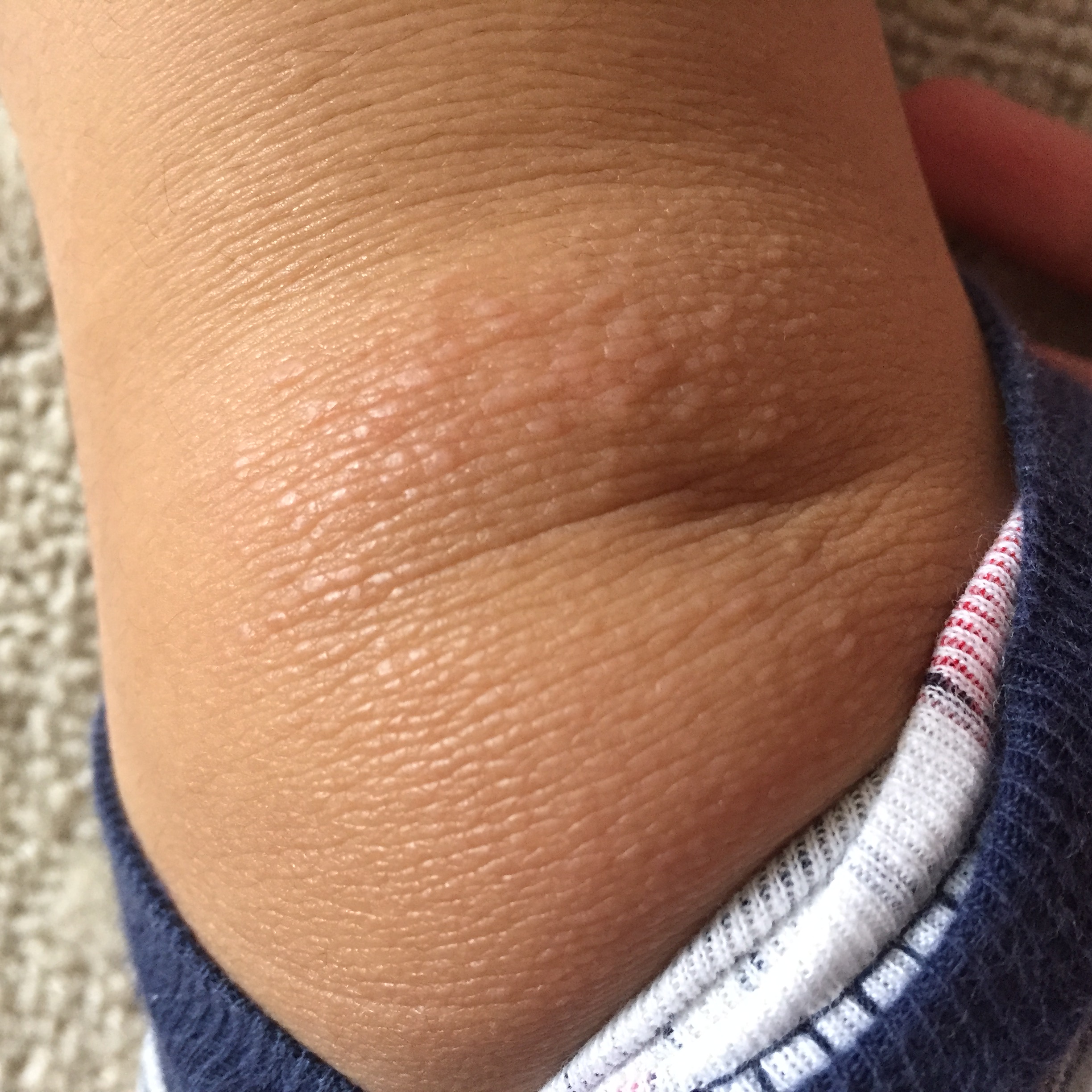 皮肌炎或多发性肌炎的诊断标准,成人皮肌炎与儿童皮肌炎区别