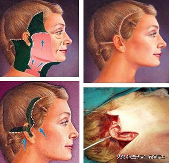 法令纹最新整形消除法,怎样医疗美容去除法令纹