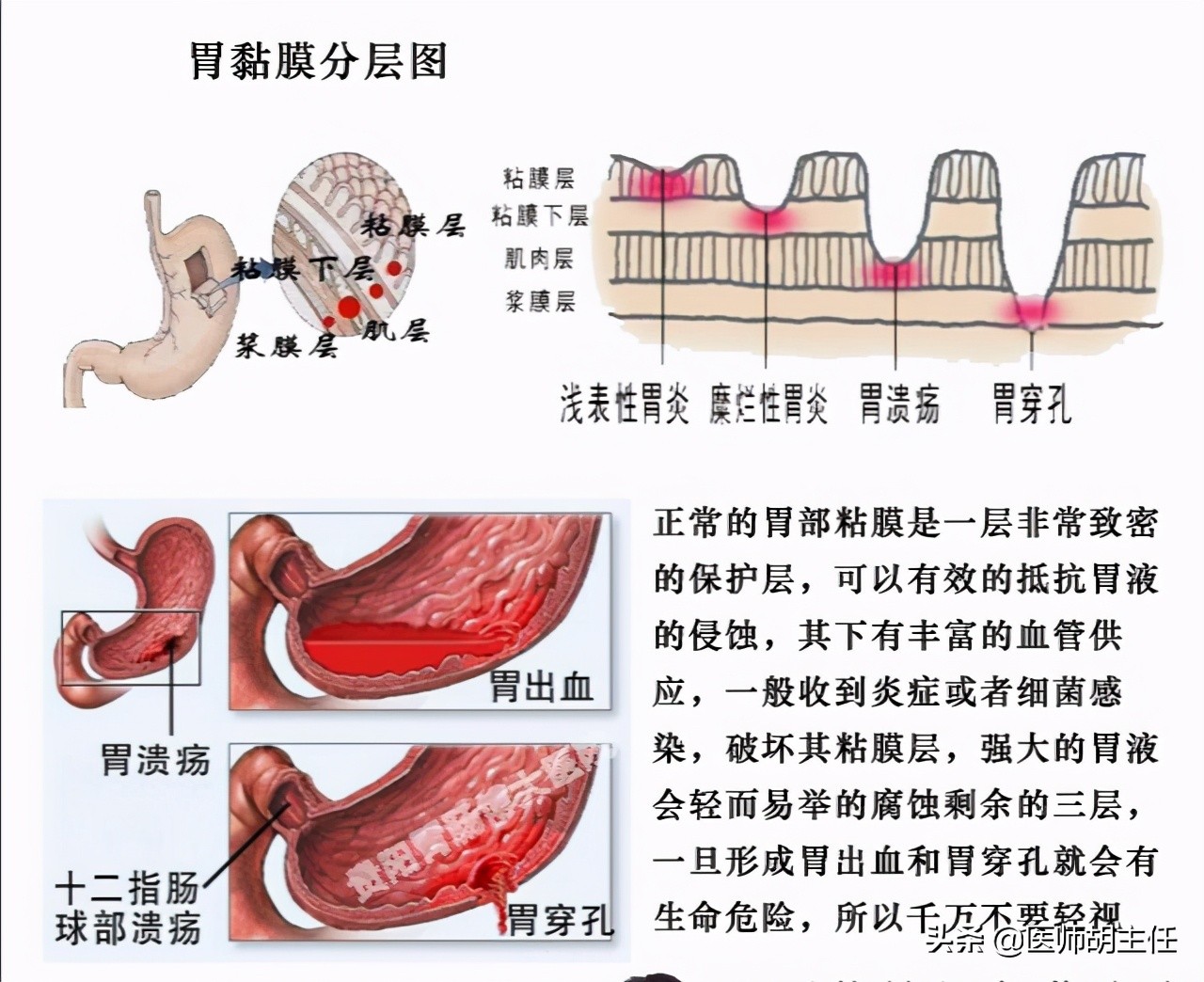 长期吃阿司匹林胃糜烂了怎么办呀,服用阿司匹林怎么保护胃粘膜