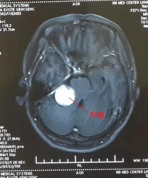 眼皮一直跳是哪里神经出问题了,眼皮总跳眼部神经抽动能放血么