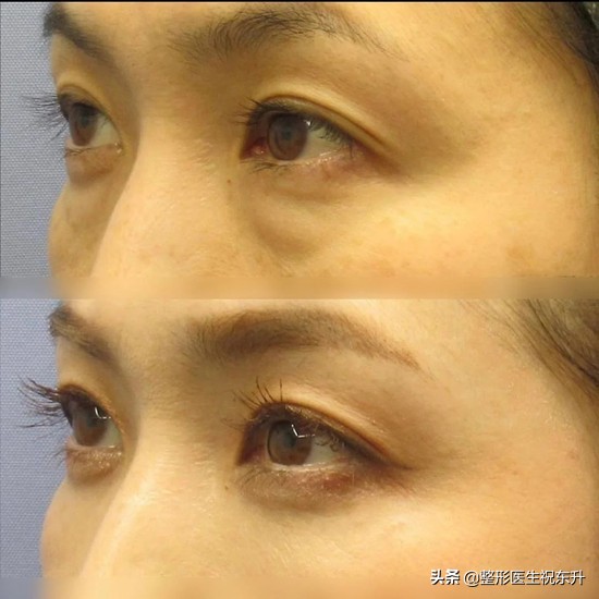 眼袋手术的真实感受,做过眼袋的人视频