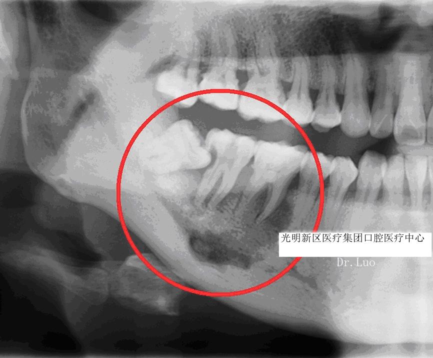 智齿蛀牙痛有什么有效方法止痛,智齿旁边牙松动蛀牙如何处理