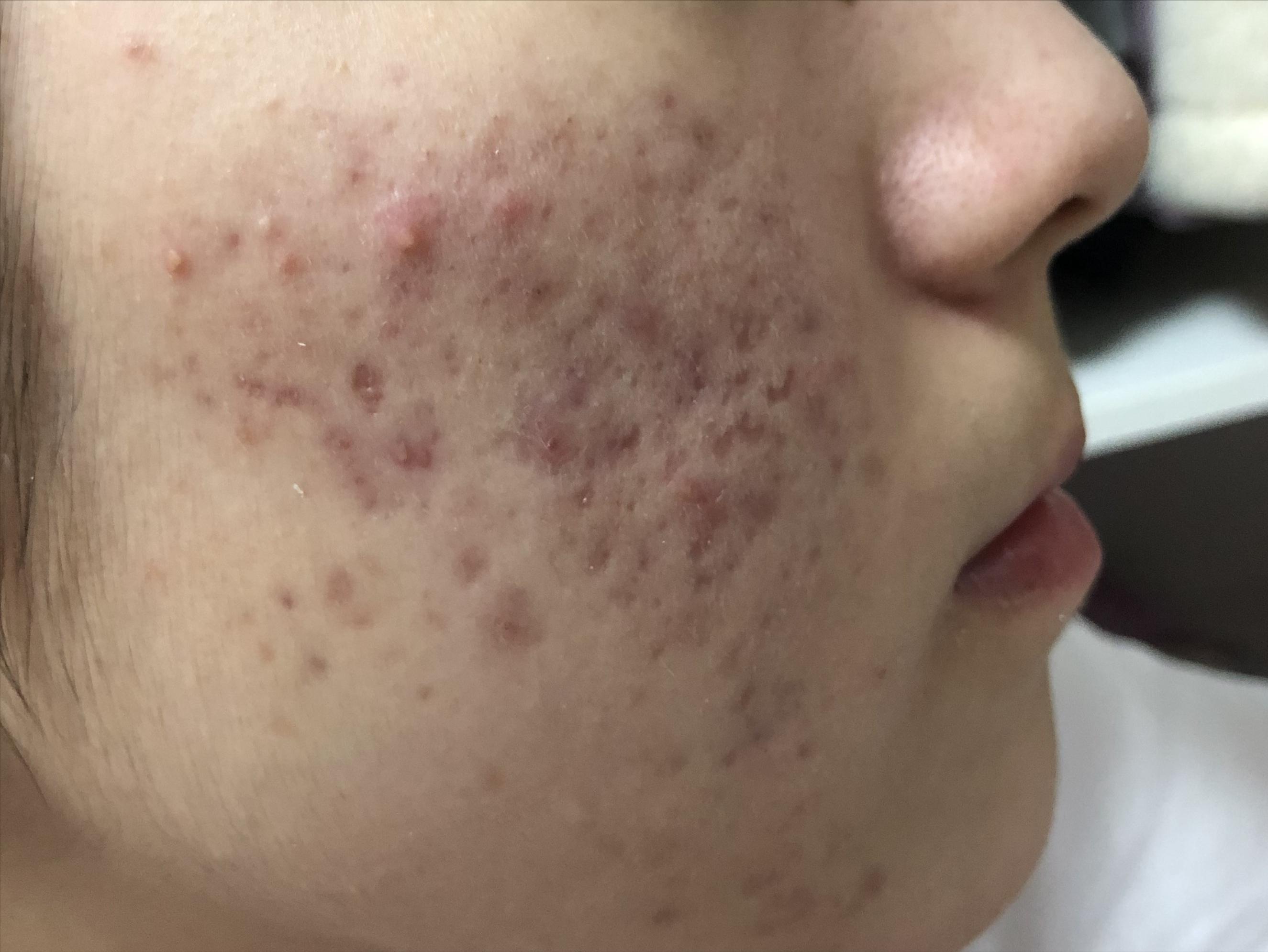 17岁的孩子身上脸上长了好多痘痘,17岁女孩脸上长好多痘痘怎么办