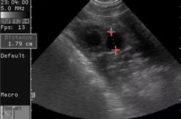 卵泡大小和数量正常范围是多少mm,卵泡数值多少范围是正常卵泡