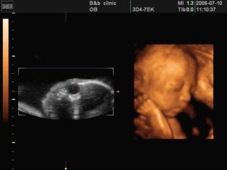 四维彩超电话预约后还需要排队吗,做四维彩超排队视频