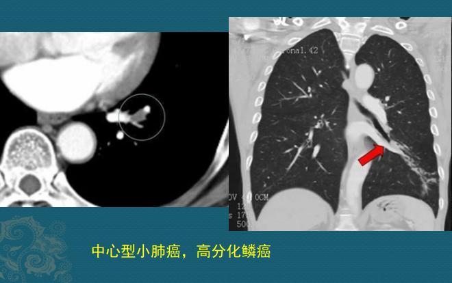 新冠肺部感染应对,新冠肺癌抗癌