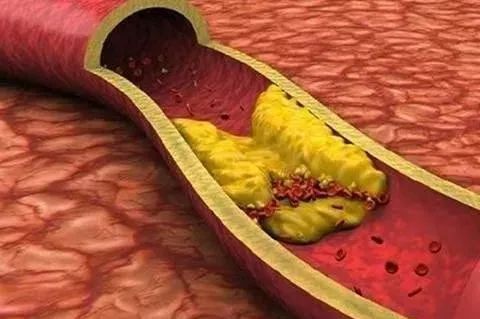 血脂粘稠能调理到正常吗,血脂粘稠能恢复正常吗