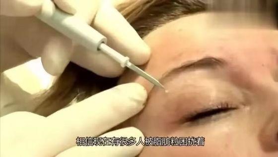 脂肪粒应该怎样用针挑,脂肪粒用针挑越挑越多