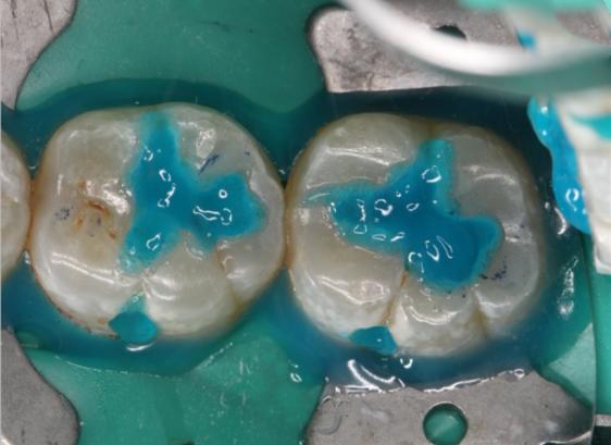 牙齿蛀牙怎么治疗,治疗蛀牙的视频