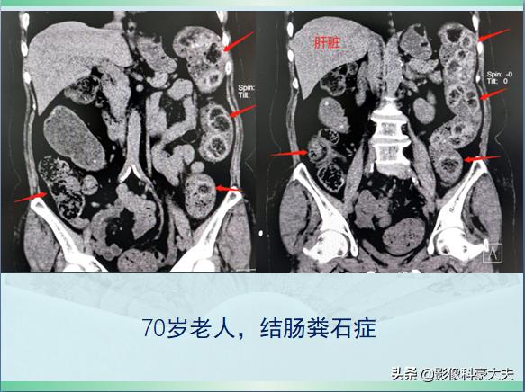 关于便秘的一些事儿,来聊聊便秘