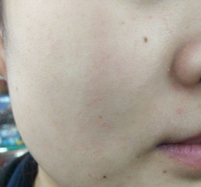 皮肤角质层薄容易泛红怎么解决,脸颊角质层薄脸会红那要怎么办
