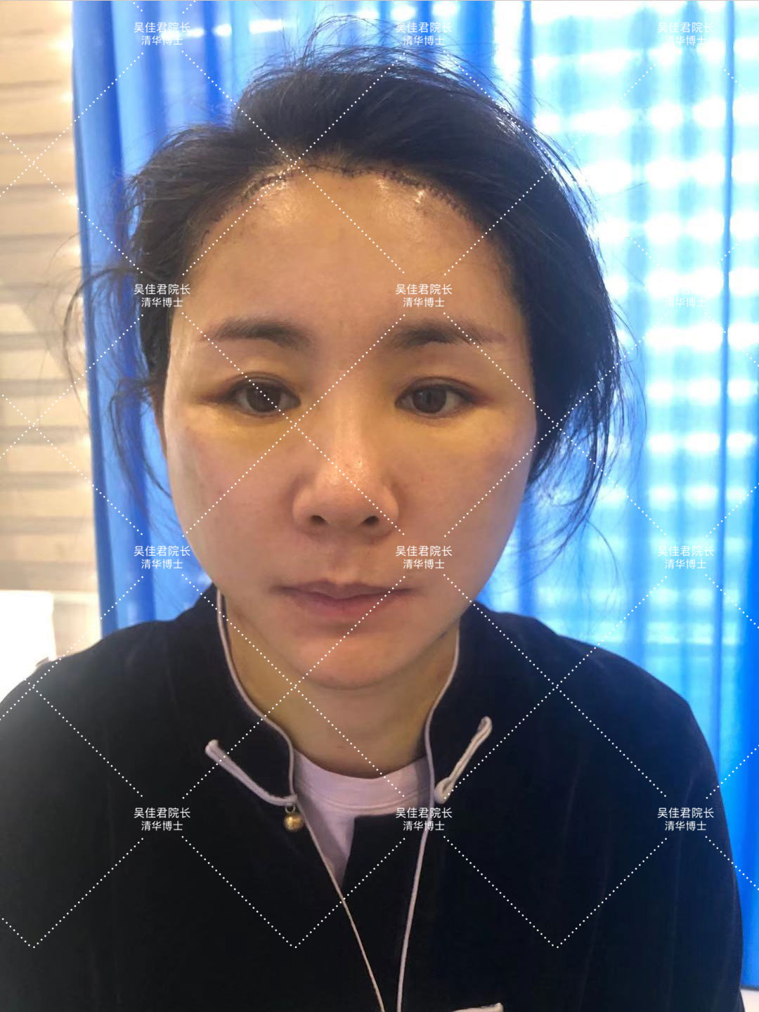 拉皮手术后三个月的恢复过程,拉皮术后10天白天可以不戴头套吗