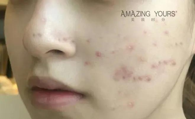 痘印怎么去除最快最好方法,痘印色素沉着怎么快速去除