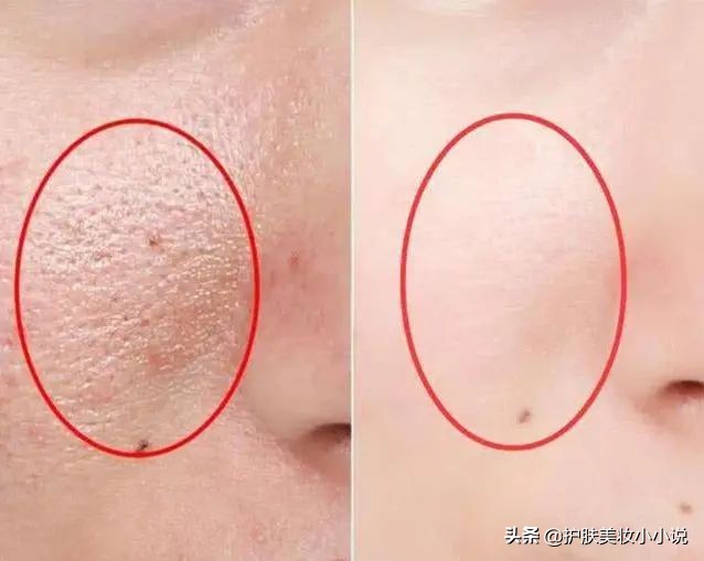 螨虫钻进皮肤怎么办,螨虫毛孔粗大擦什么药
