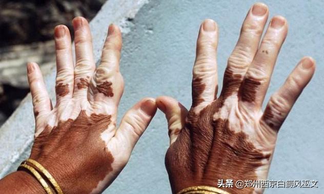 白癜风对我们的身体有哪些影响,白癜风对身体有何影响