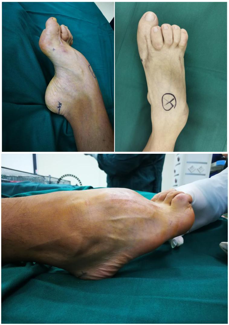 太原中心医院骨科汾东一病区完成首例ilizarov外固定矫形高弓足