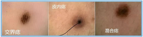 黑痣和黑痣区别图片,黑痣与一般痣癌变的概率