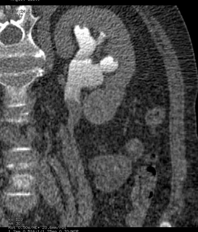尿路造影输尿管间断显影,静脉尿路造影和排泄性尿路造影
