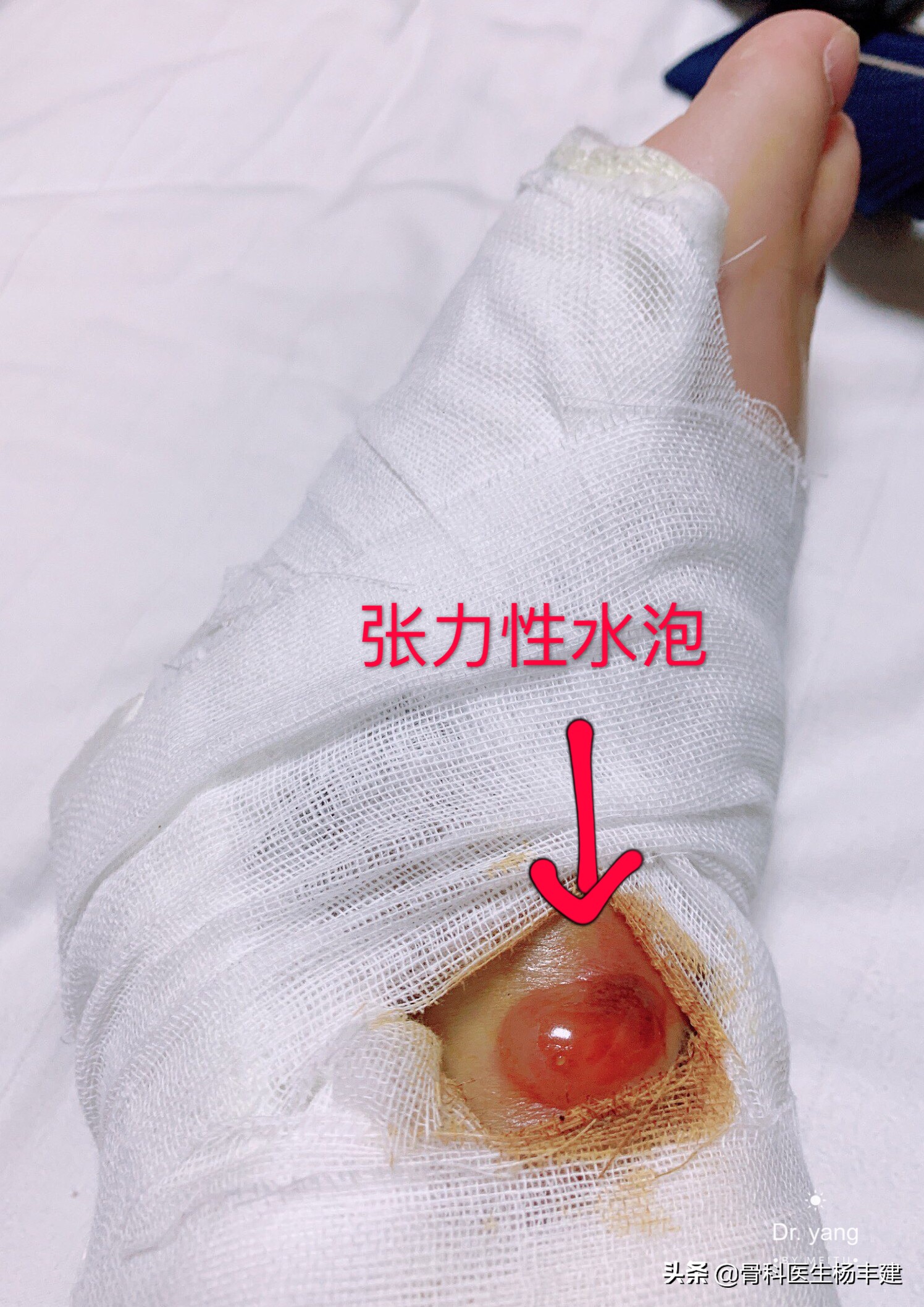 什么样的脚踝骨折适合保守治疗,什么样的腿骨骨折需要手术