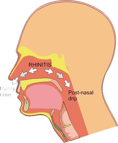 宝宝发烧喉咙痛怎么办最有效,6岁宝宝喉咙痛是怎么回事