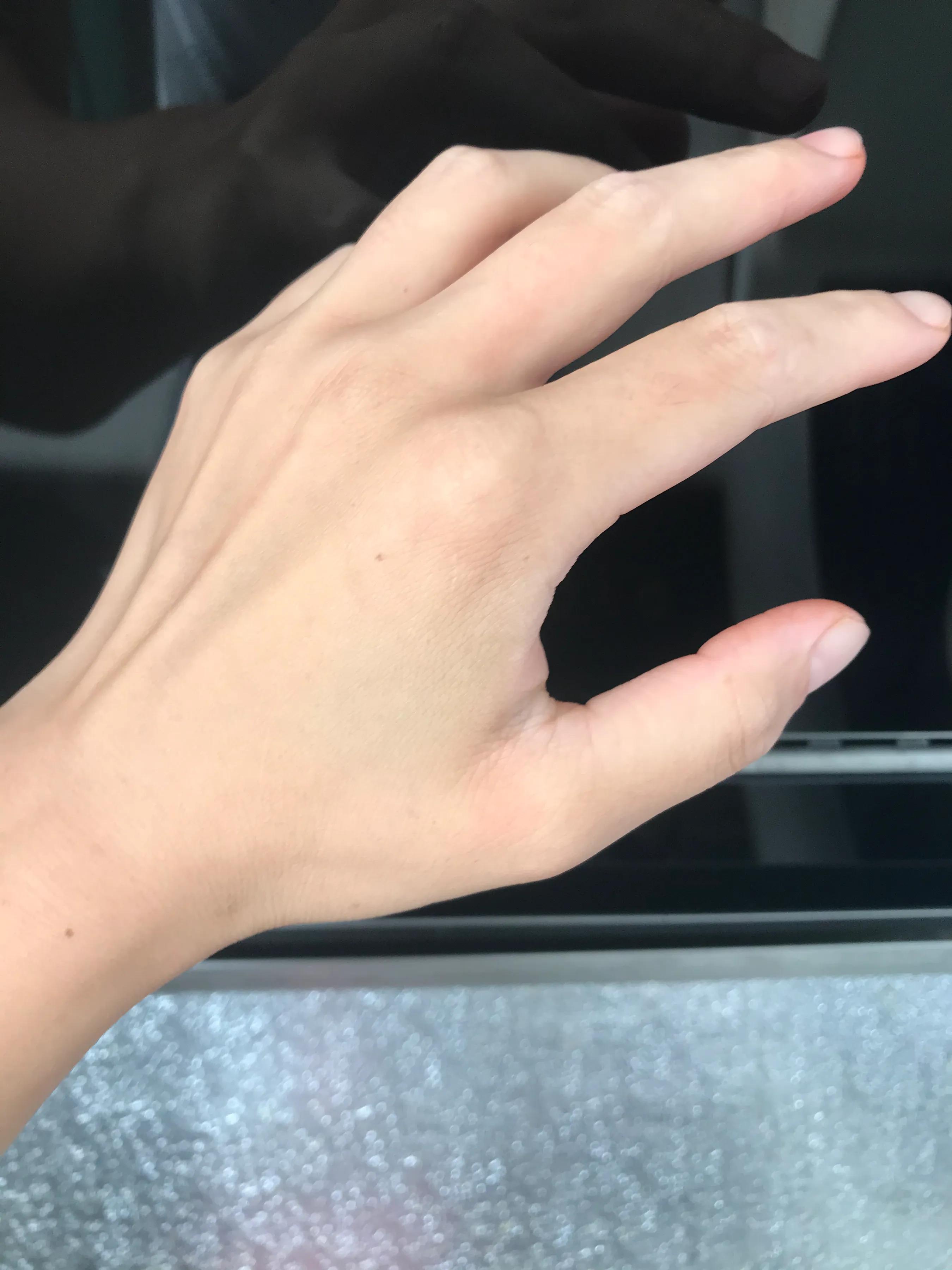 烫伤口红肿没起泡痛痒怎么回事,开水烫伤怎么处理不会留疤