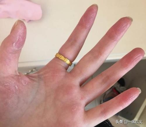 手指长小水泡瘙痒汗疱疹怎么治疗,手指夏天长小疱疹痒