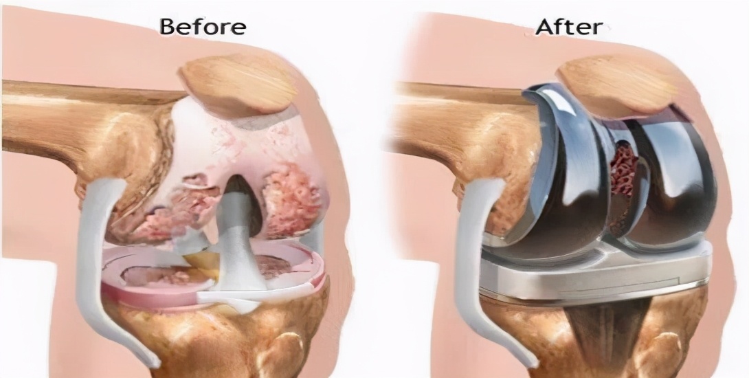 膝骨关节炎只能“换关节”?看看关节外科大夫如何“保膝”